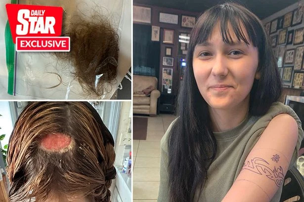 Teen's hair dye hell as 'hairdresser burns hole in scalp – and still charges her £37'