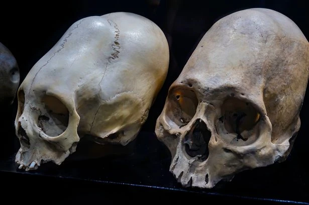 'Conehead humans' could be aliens as DNA tests leave scientists baffled