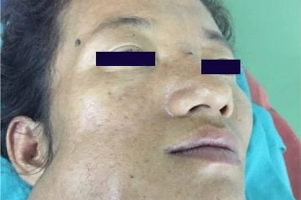 Woman, 27, baffles doctors with huge jaw – needing bone from her leg to fix