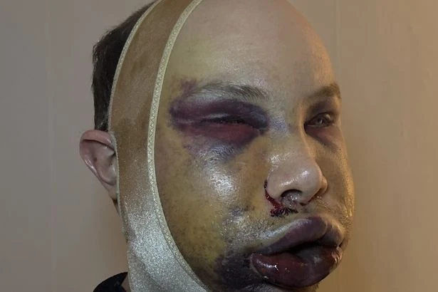 Influencer left 'unrecognisable and blind' after extreme facelift that surgeons in Turkey refused