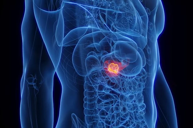 Major cancer breakthrough as lifestyle choice tied with deadly disease