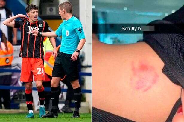 Liverpool legend's nephew 'bit' by 'scruffy bastard' opponent shows off gruesome injury