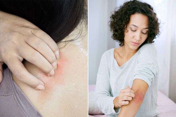 Does scratching an itchy rash really make it worse? Scientists have finally worked it out