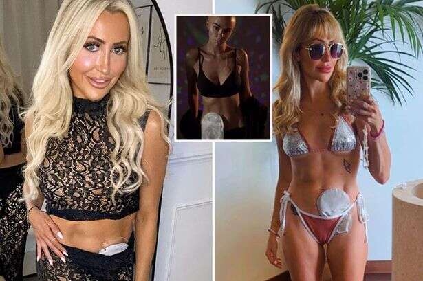 'I’ve got a stoma just like Coronation Street star – losing bum gave me life back'