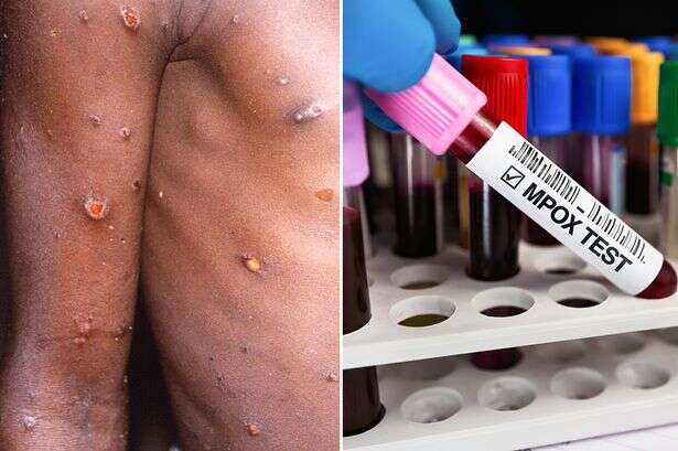 NHS lists eight mpox symptoms to look out for as deadly strain spreads to UK