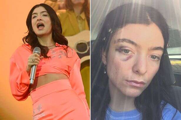 Lorde sparks concern with snaps of black eye as fans ask star 'are you okay'