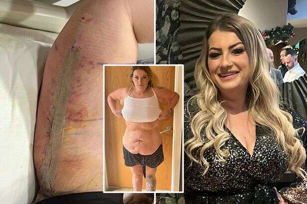 Mum left with 'rotting' tummy tuck becomes 'first Brit to sue over botched op'