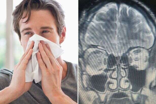 Man who thought he had runny nose all the time told it was something else - brain leak