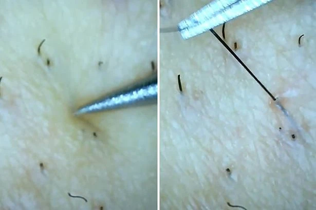 Ingrown hair like 'rubber band' pulled free from leg in oddly satisfying video