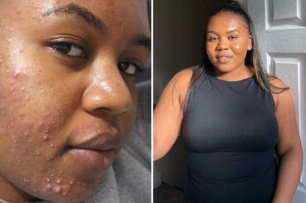 'I’ve had acne for 14 years and feel beautiful – you shouldn’t pop your spots'