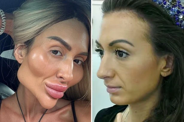 Model with 'world's biggest cheeks' shows what she looked like as natural 26-year-old