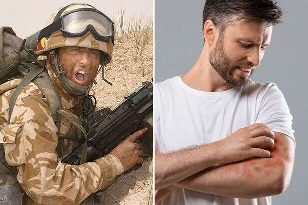 British Army to stop being so fussy and let recruits with acne and eczema sign up