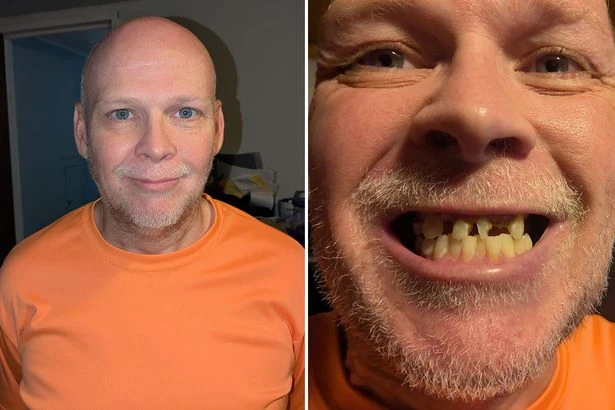 Single dad can't eat solid food after half his teeth rotted in 'domino effect'