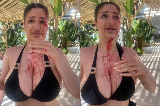 Brit, 20, 'covered in blood' after being hit by champagne bottle in Marbella sunbed row