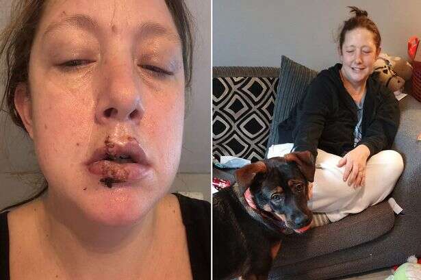 Woman 'traumatised' after own dog chewed chunk of her lip off but she doesn't blame her