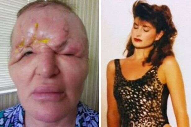 Model left looking like a 'monster' after botched treatment caused her head to 'collapse'