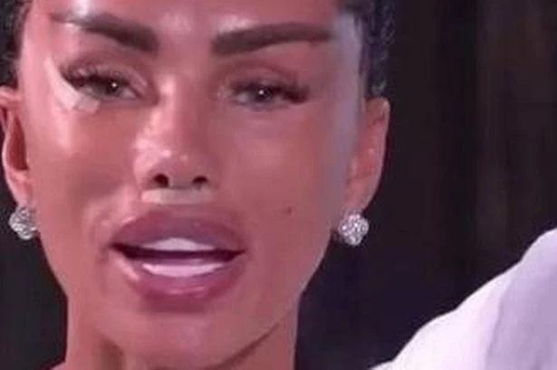 Katie Price pulls stitches out of own face in sickening facelift blunder
