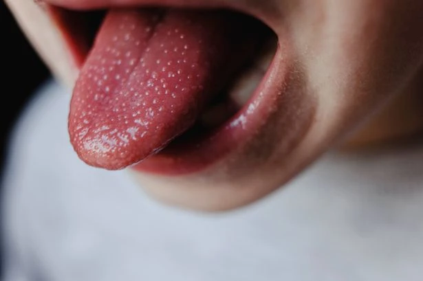 Five Scarlet fever symptoms to spot as illness that mostly affects children spreads