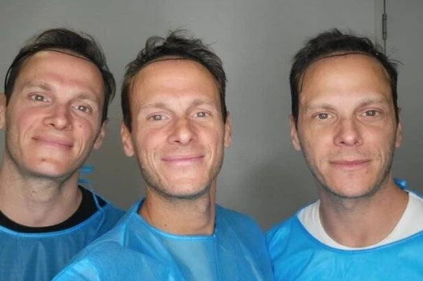Celeb triplets have world's first matching £5k hair transplants after going bald together