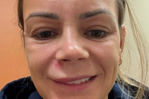 Woman's warning after severe reaction to popping pimple in 'triangle of death'