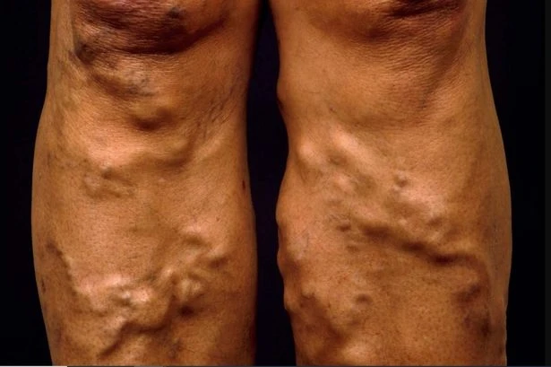 Warning issued for anyone who has varicose veins to act now