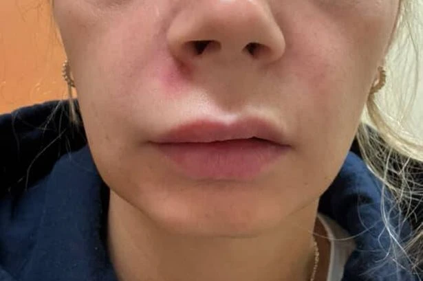 Woman rushed to hospital after popping spot in 'triangle of death' on her face