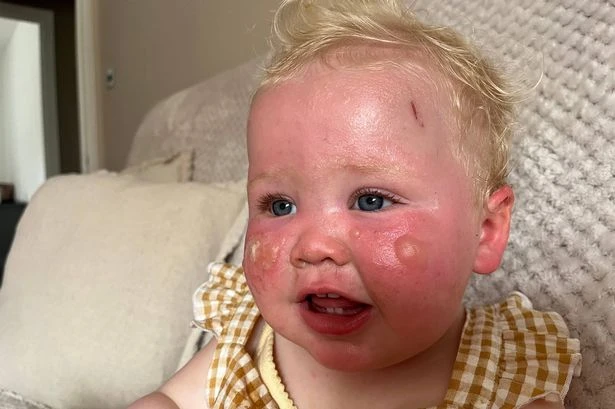 Mum's warning as baby suffers severe burns despite factor 50 sun cream