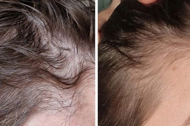 Woman's hair transformation with 49p supplements after 'disaster' left her tresses damaged