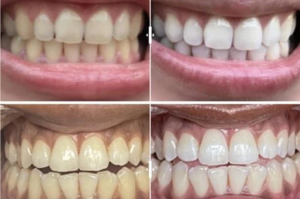 Amazon 'fast acting' teeth whitening strips reduced to £19 and 'no sensitivity after use'