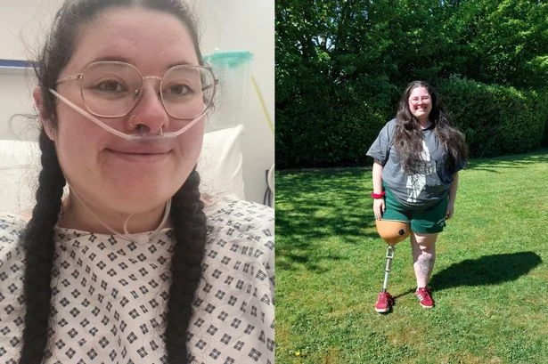 NHS nurse, 26, has leg amputated after noticing 'aching' leg pain