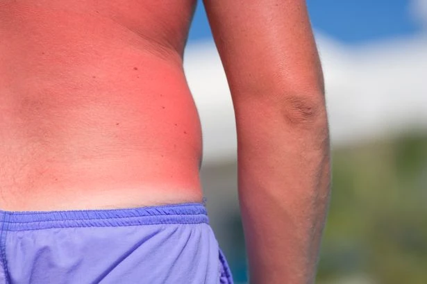What happens after you get sunburned and the hidden effects of going red