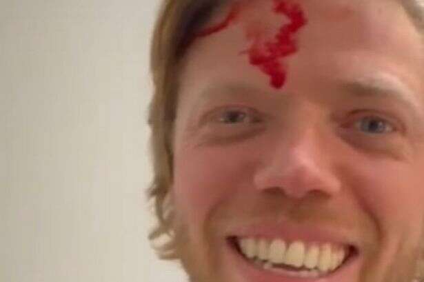 Rob Beckett explains 'unbelievable' way he got head injury where blood 'poured out'