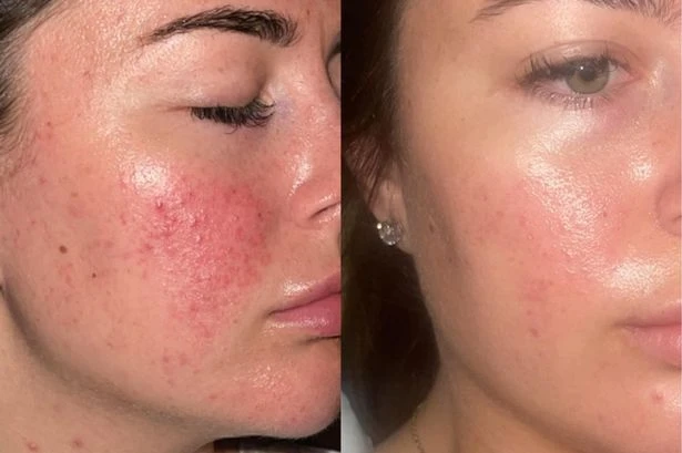 Teens praise 'life-changing' skincare products that leave them feeling 'more confident'