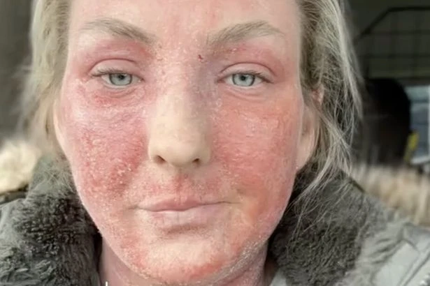 Birmingham woman says treatment left her 'looking like a burnt hamster'