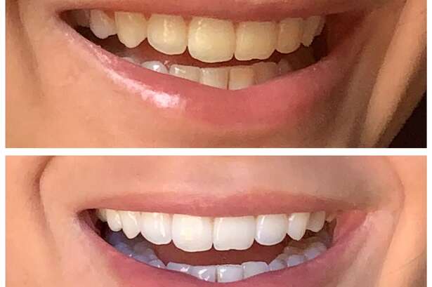 Shoppers say £16 teeth whitening pen is a 'must-have' for 'visibly whiter' smile