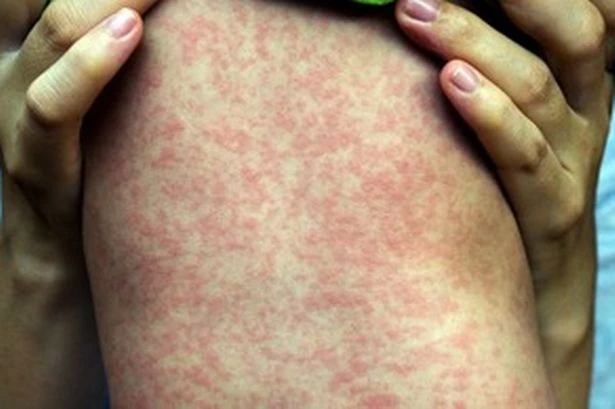 Cases of 'highly infectious virus' rise in Birmingham leading to calls for parents to act