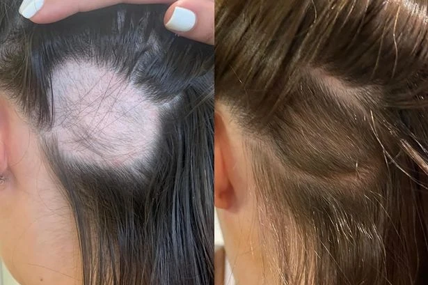 Amazon's £14 hair growth gummies hailed an 'absolute saviour' for hair loss and thinning