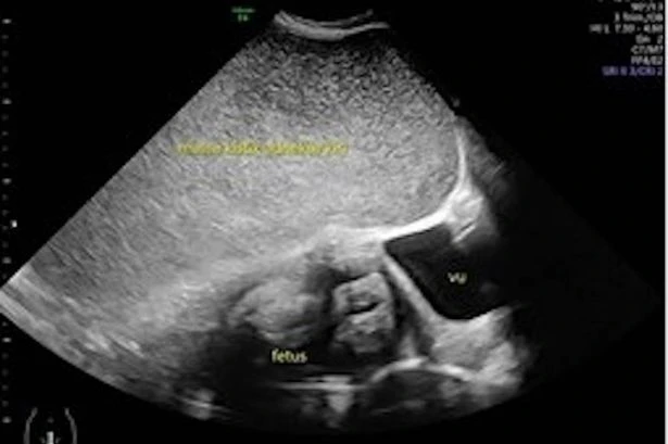Pregnant woman complains of tummy pain before ultrasound scan unveils alarming find
