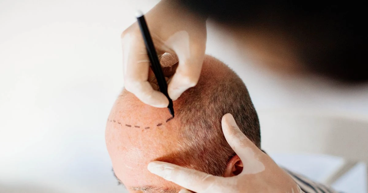 Brit dies in Turkey after undergoing hair transplant as 'homicide' probe launched