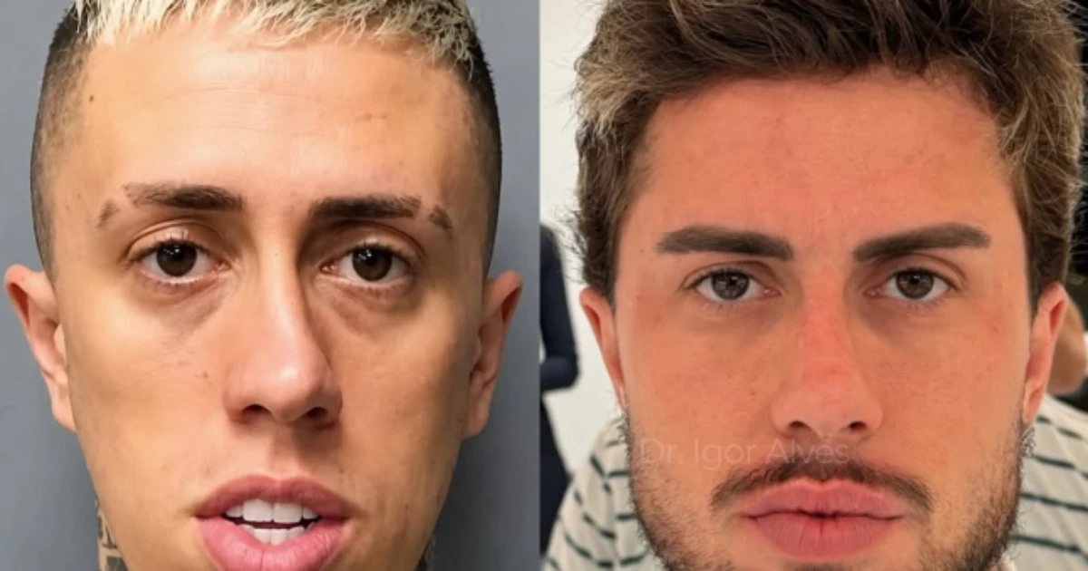MC Daniel impressiona com antes e depois após procedimentos estéticos: 'outro CPF'