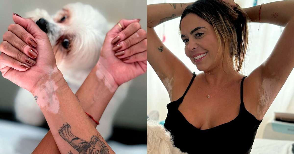 Marília Pinheiro fala sobre diagnóstico de vitiligo e aceitação: 'Faz parte de quem sou'