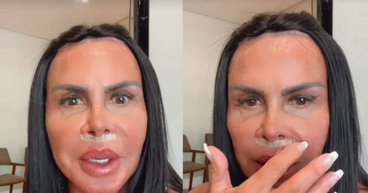 Gretchen retira preenchimento labial com substância polêmica após 20 anos