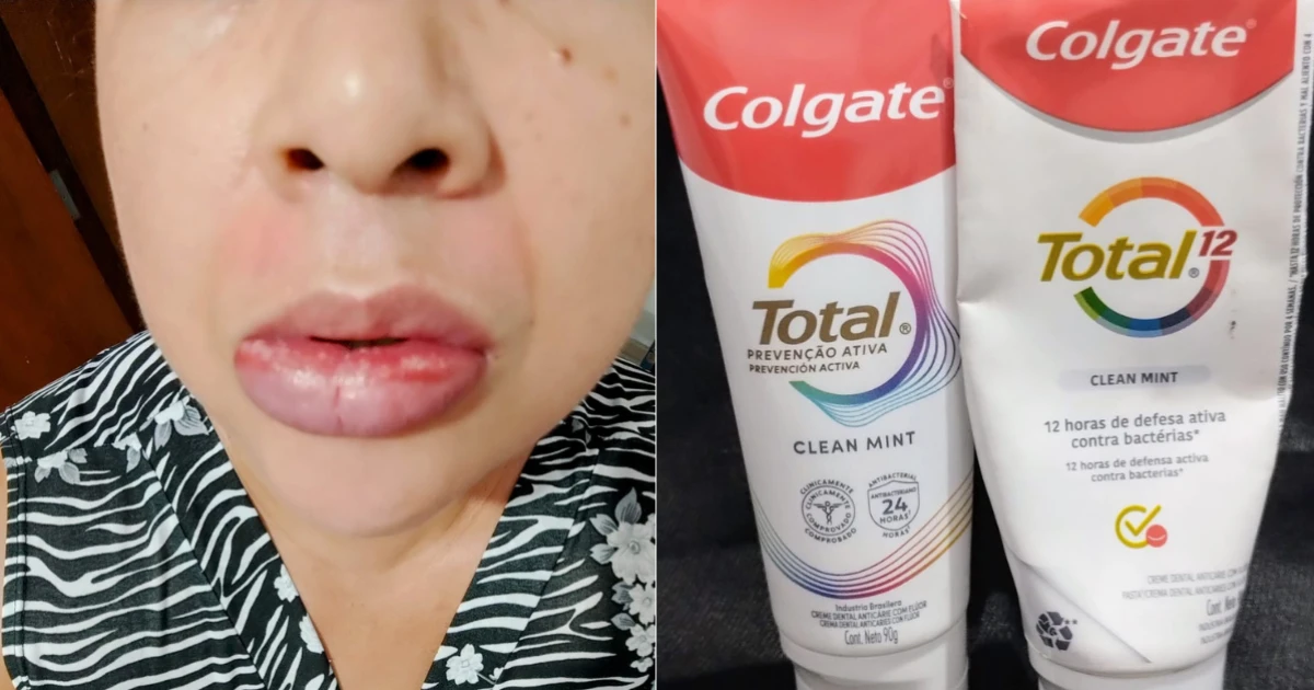 Mulher que ficou com boca inchada por uso de creme dental irá processar Colgate: 'Angústia pela dor e fome'