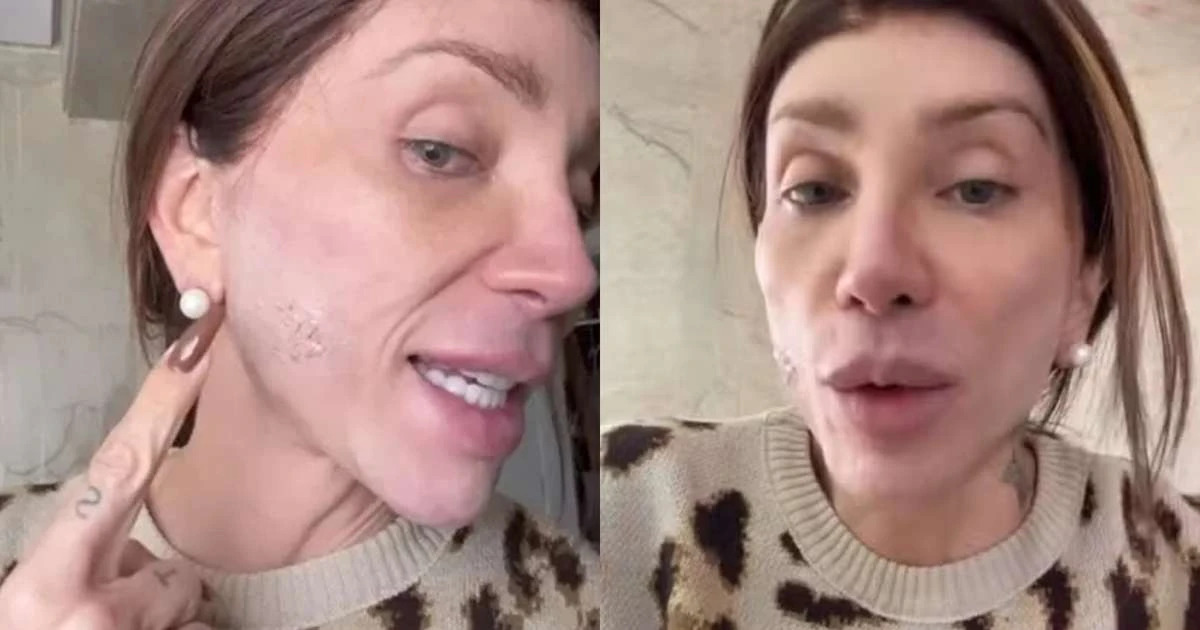 Maya Massafera detalha resultado após novo procedimento no rosto: 'Em carne viva'