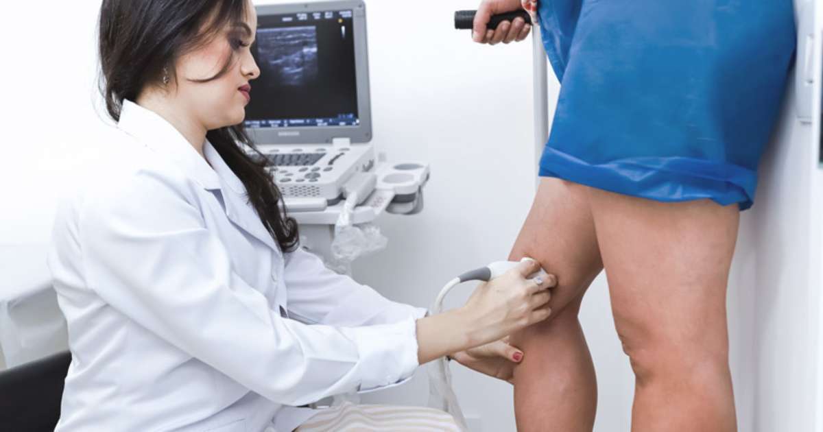 Laser endovenoso mira resultados contra varizes