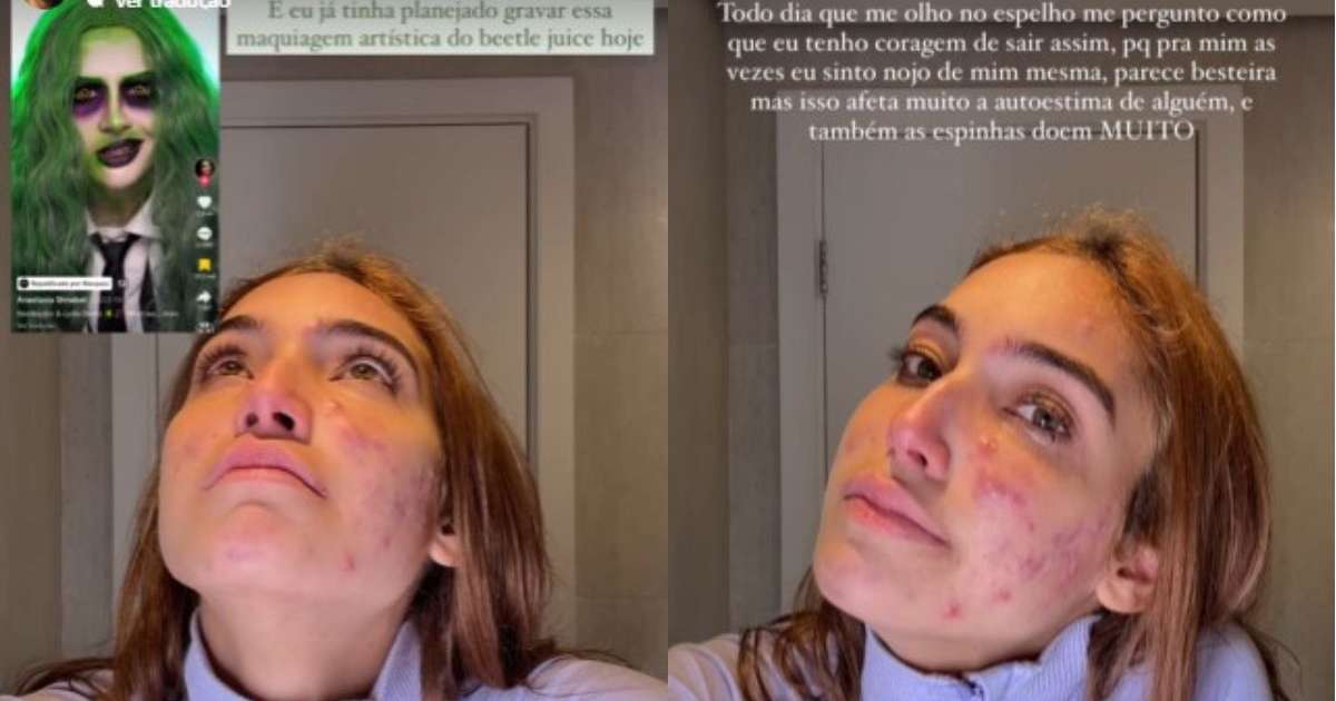 Vanessa Lopes chora ao expor crise de acne: 'Pra que fantasia se estou um monstro?'