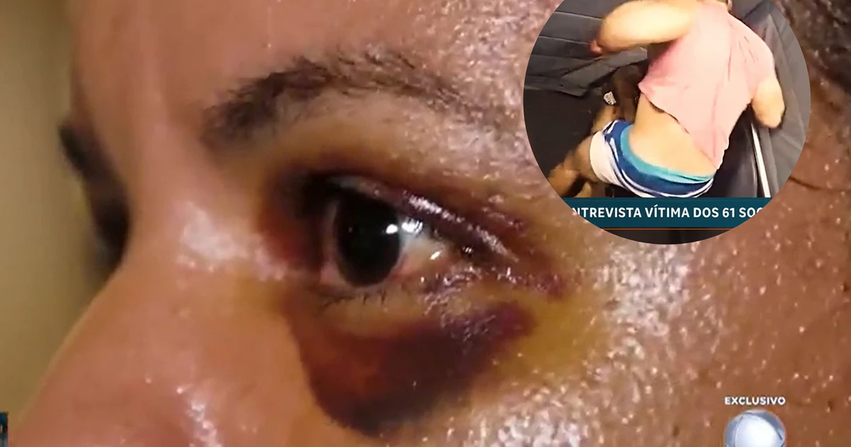 Agredida com 61 socos em elevador mostra rosto machucado e diz que namorado queria matá-la: 'Tentei me manter viva'