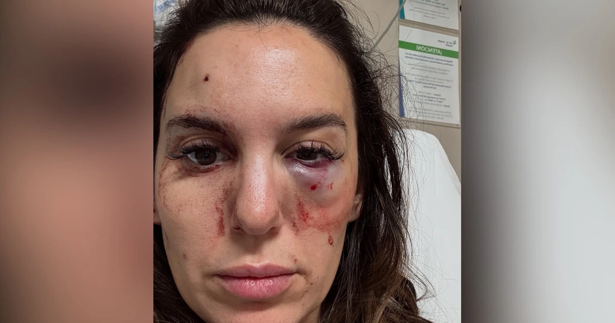 O drama da estrela da Disney que teve o rosto baleado no aniversário do marido: 'A 1 milímetro de me deixar cega'