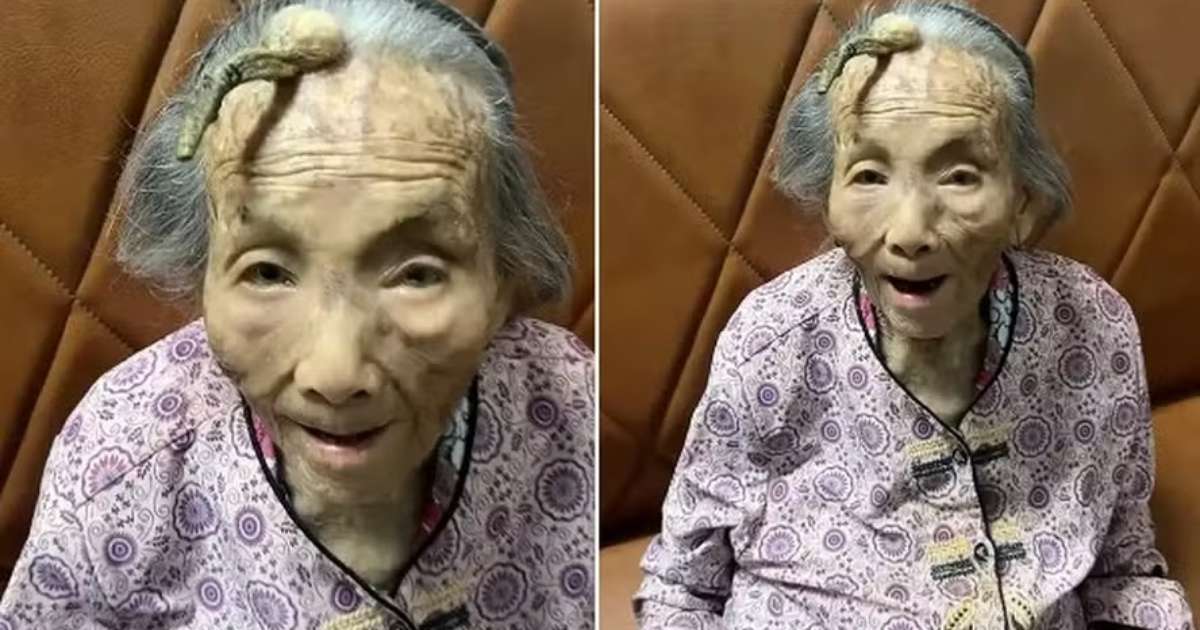 Idosa de 107 anos choca ao aparecer com 'chifre' de 10cm na testa; saiba o motivo