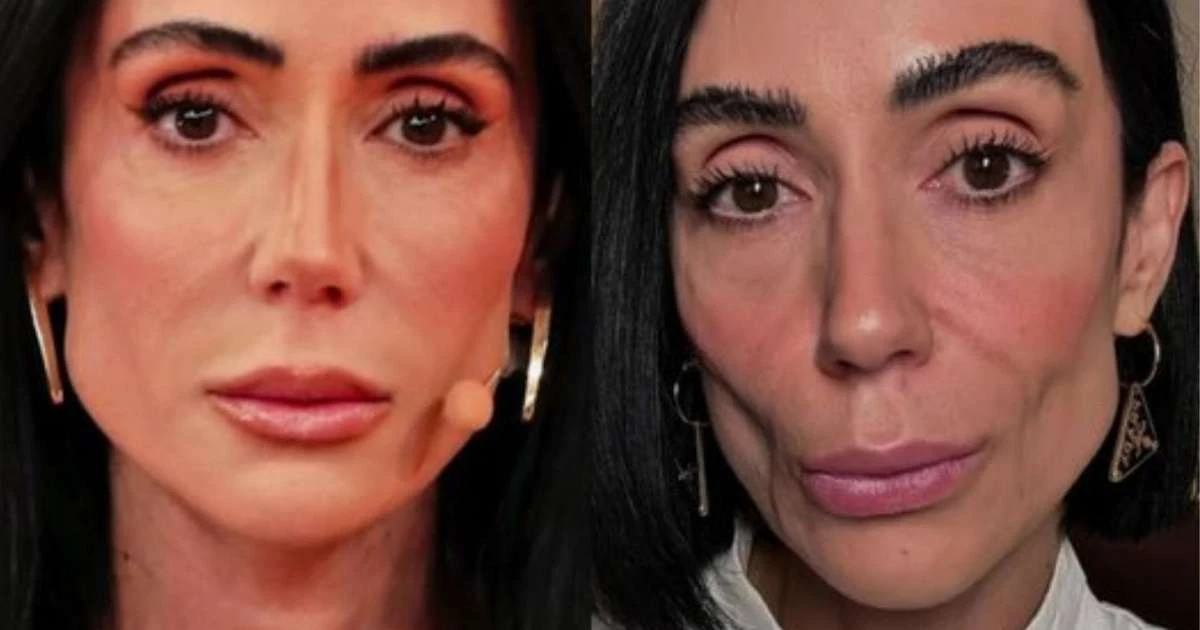 Preenchimento facial exagerado causa flacidez em Michelle Barros, explica especialista